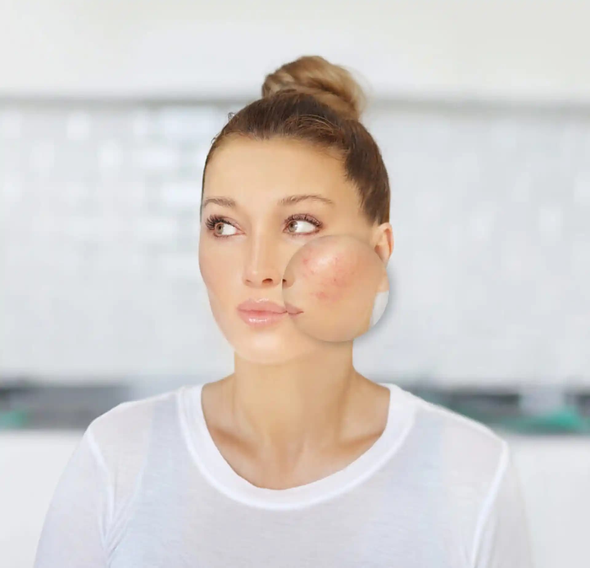 Rozalı Cilt Nedir Belirtileri, Nedenleri ve Etkili Tedavi Yöntemleri