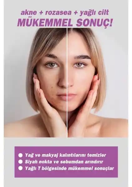 Rozalı Yüz İçin Doğru Bakım ve Ürün Seçenekleri Rehberi