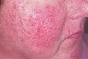 Rozasea Belirtileri, Nedenleri ve Etkili Tedavi Yöntemleri Hakkında Bilgiler