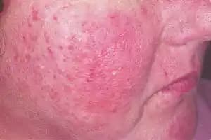 Rozasea Belirtileri, Nedenleri ve Etkili Tedavi Yöntemleri Hakkında Bilgiler