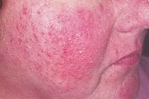 Rozasea Nedir, Belirtileri ve Doğru Cilt Bakımı Yöntemleri Hakkında Bilgiler