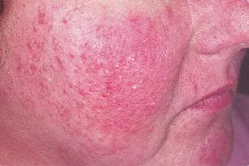 Rozasea Nedir, Belirtileri ve Doğru Cilt Bakımı Yöntemleri Hakkında Bilgiler