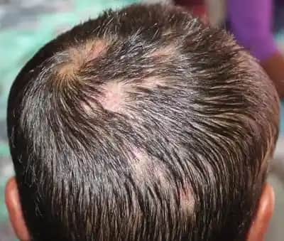 Saç Derisi İltihabının Belirtileri Nedenleri ve Etkili Tedavi Yöntemleri