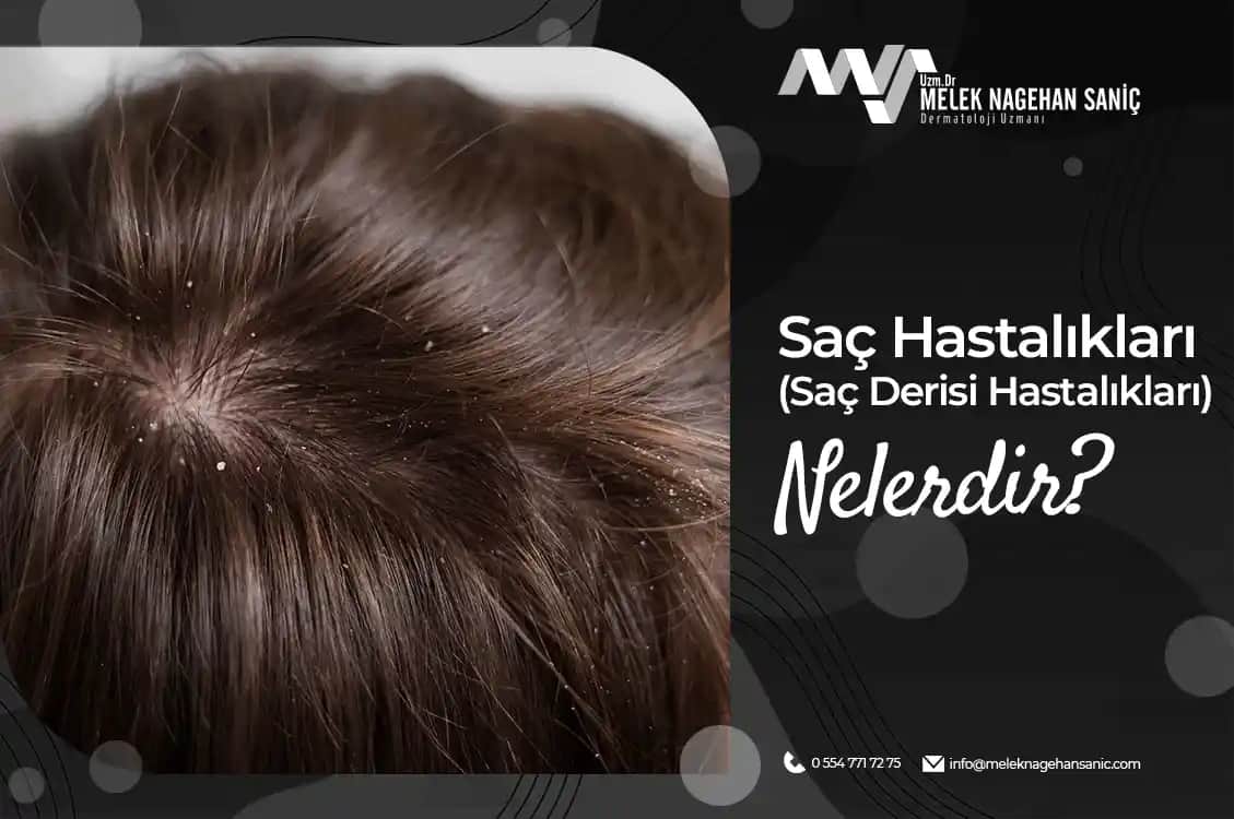 Saç Derisi Kavlaması Nedenleri Belirtileri ve Etkili Çözüm Yöntemleri