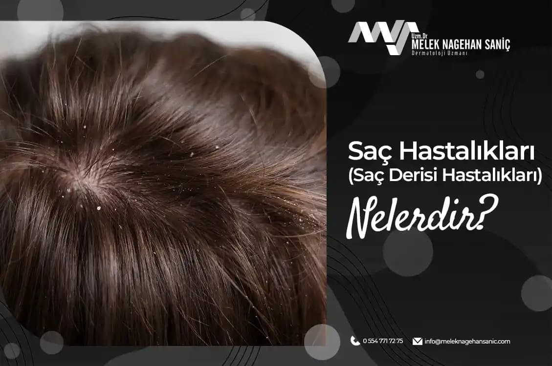 Saç Derisi Kavlaması Nedenleri Belirtileri ve Etkili Çözüm Yöntemleri