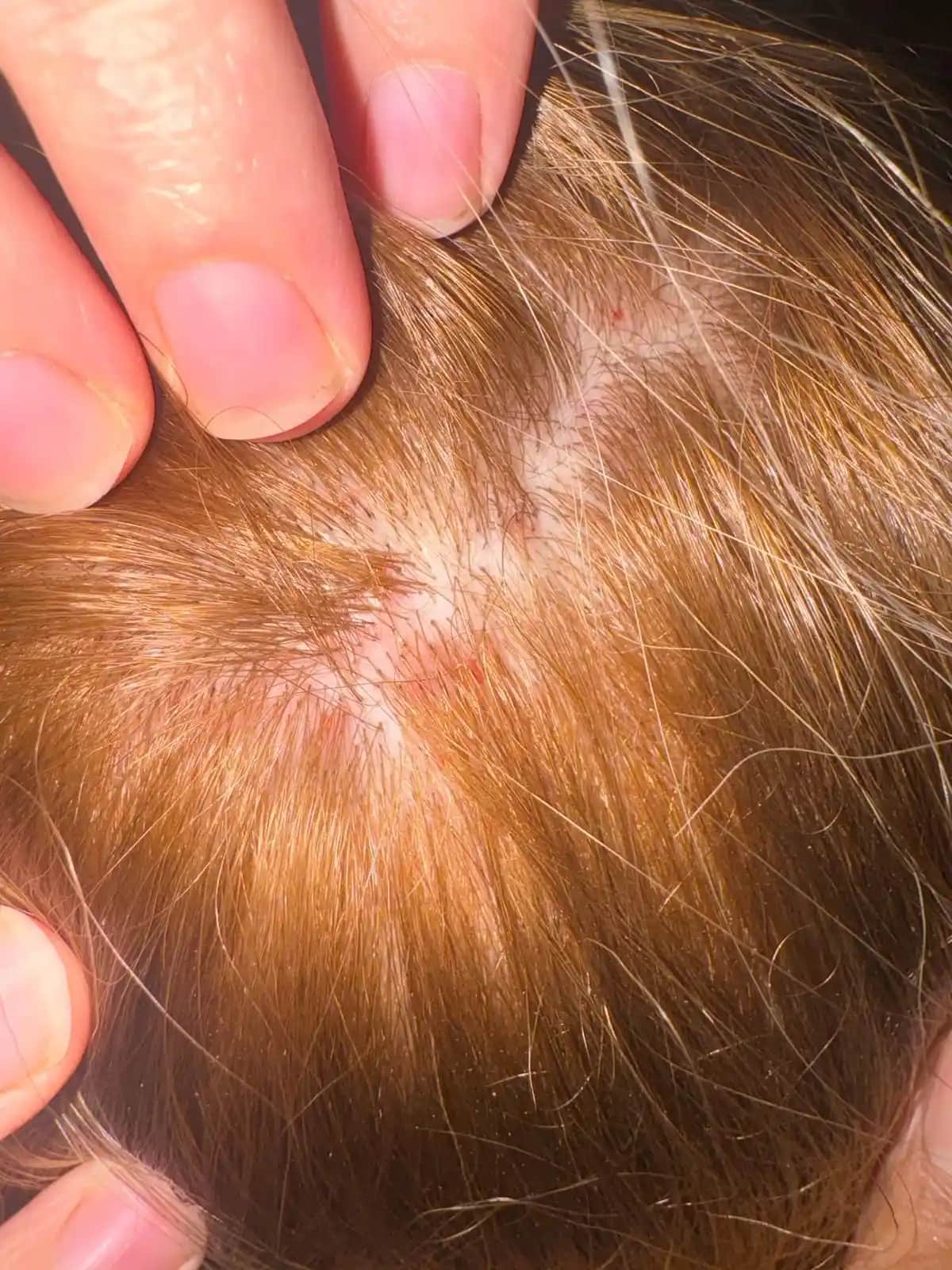 Saç Derisi Sağlığı ve Rahatsızlıkları: Nedenleri ve Etkili Çözüm Yolları