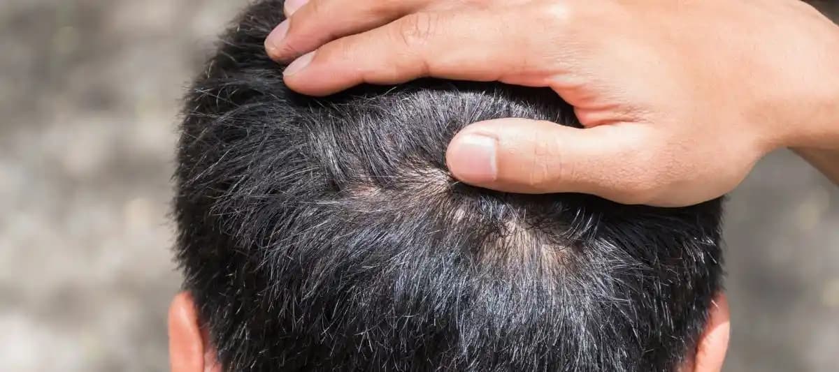 Saç Derisi Sağlığını Koruma ve Kaşıntıyı Hafifletme Yöntemleri Rehberi