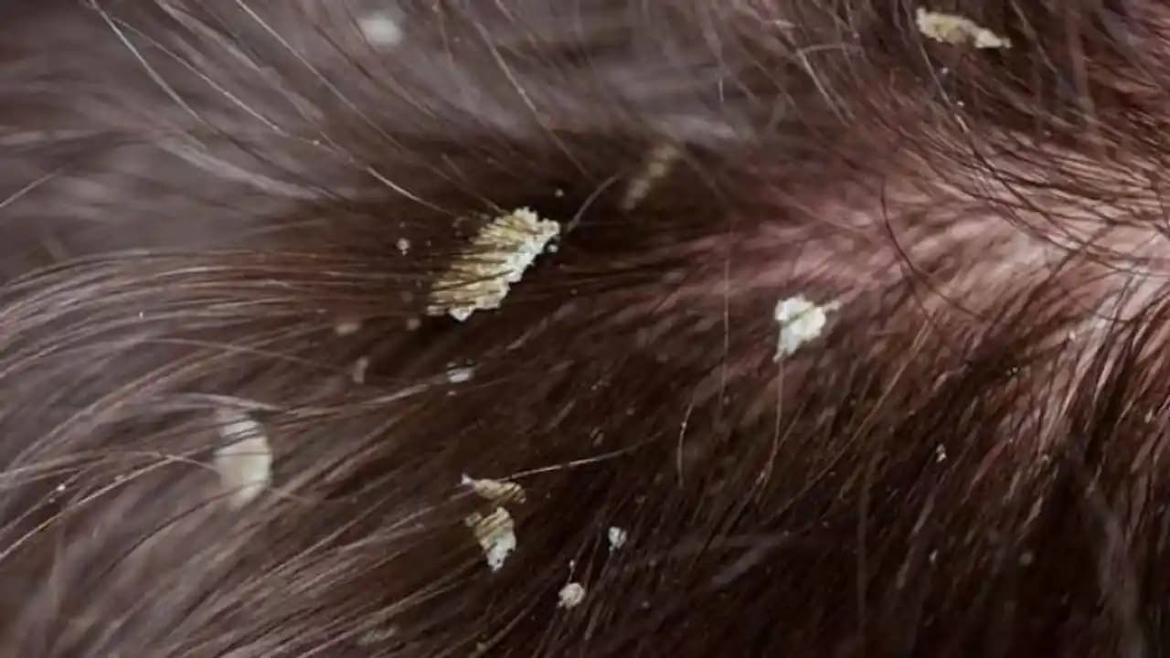 Saç Derisinde Beyaz Pullanma Nedenleri ve Etkili Tedavi Yöntemleri