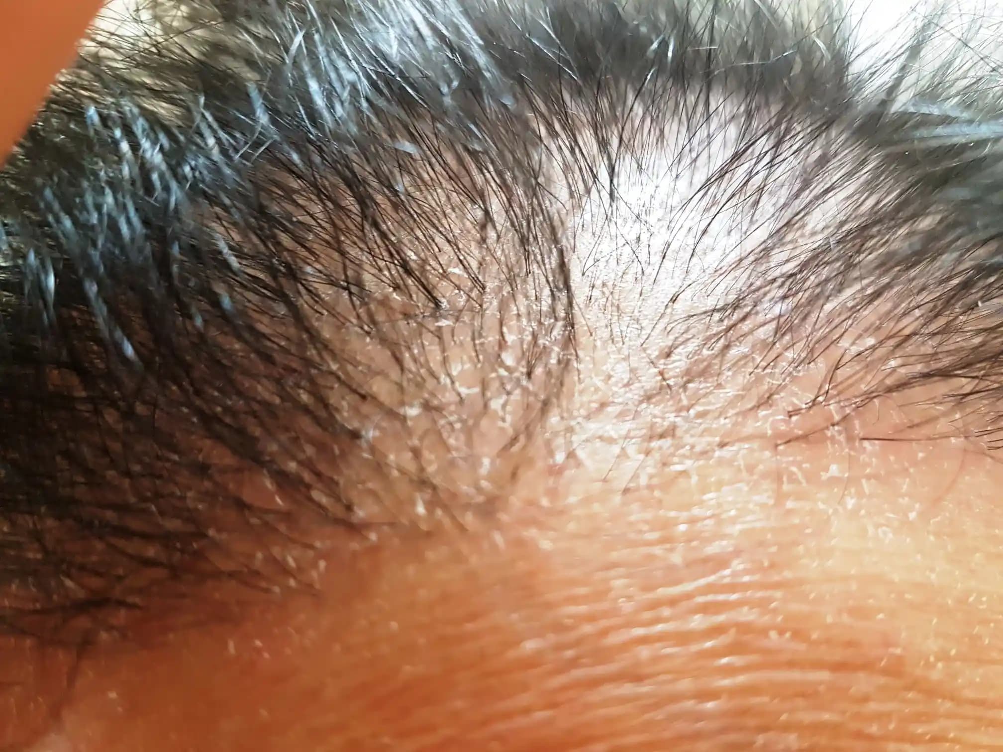 Saç Derisinde Beyaz Tortu Nedenleri Belirtileri ve Etkili Çözüm Yöntemleri