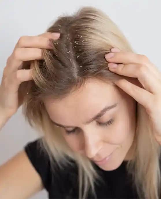 Saç Derisinde Egzama Nedenleri, Belirtileri ve Etkili Tedavi Yöntemleri