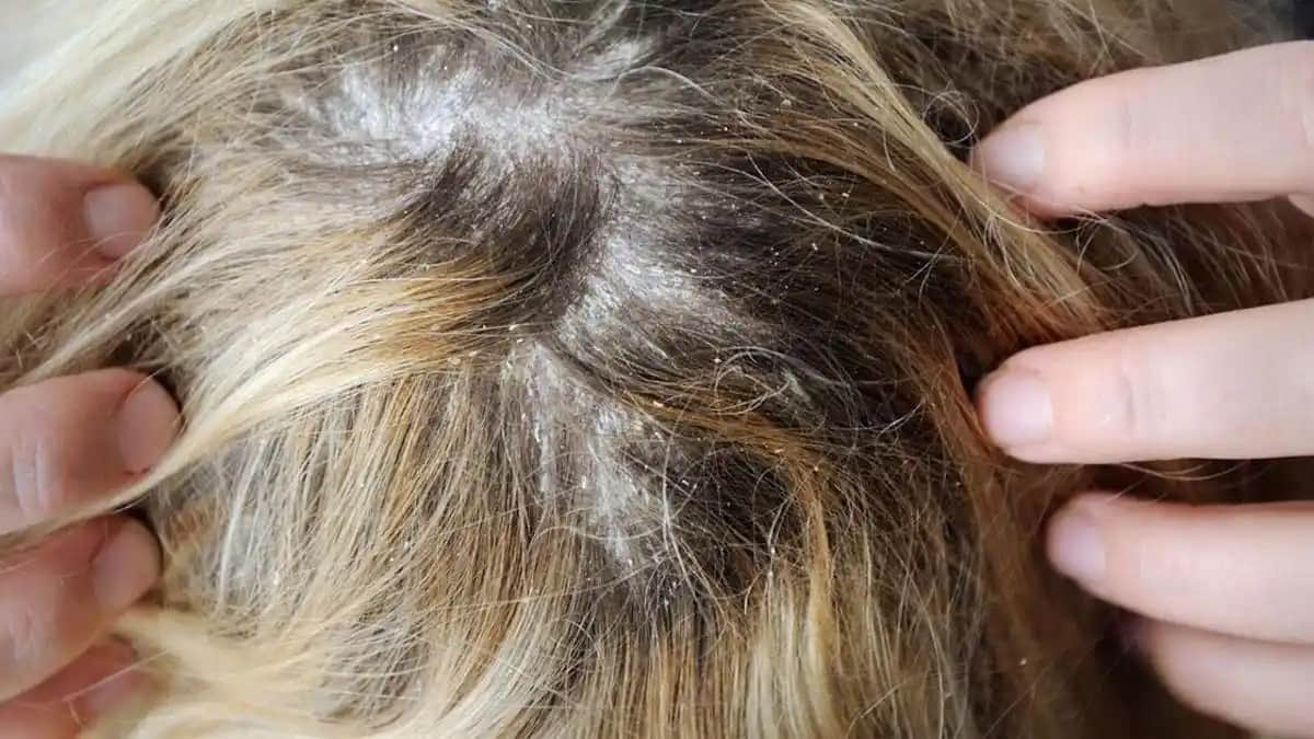 Saç Derisinde Kaşıntı ve Kepek: Nedenleri, Çözüm Yolları ve Bakım İpuçları