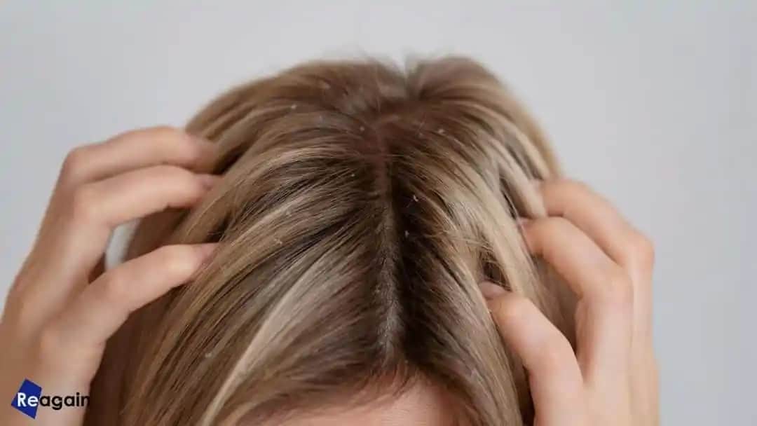 Saç Derisinde Kepek Nedenleri ve Etkili Kontrol Yöntemleri Hakkında Bilgi