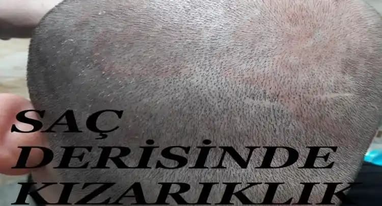 Saç Derisinde Kızarıklık Nedenleri Belirtileri ve Etkili Çözüm Yolları