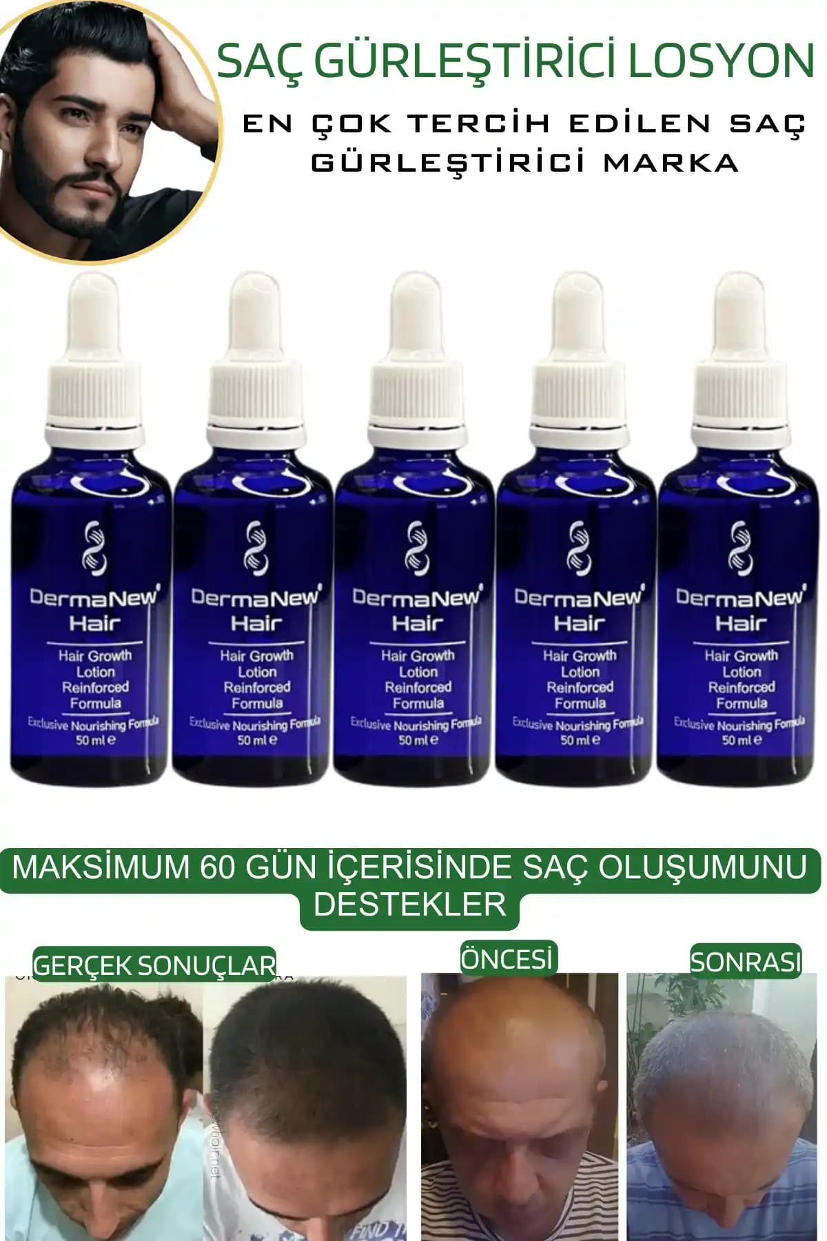 Saç Derisinde Pullanma ve Kepek İçin Doğal Çözüm Rehberi