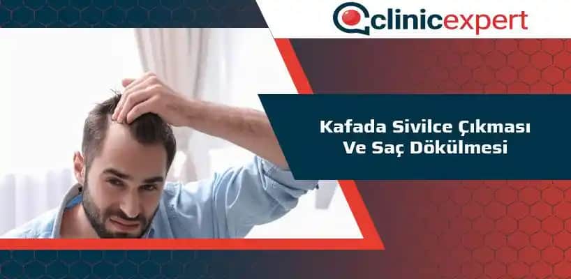 Saç Derisinde Sivilce Nedenleri ve Çözüm Yolları Bilimsel Temellere Dayalı Rehber