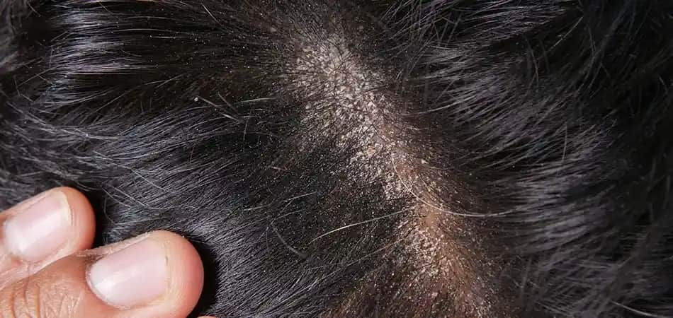 Saç Derisinde Sivilceler: Nedenleri ve Etkili Çözüm Yolları