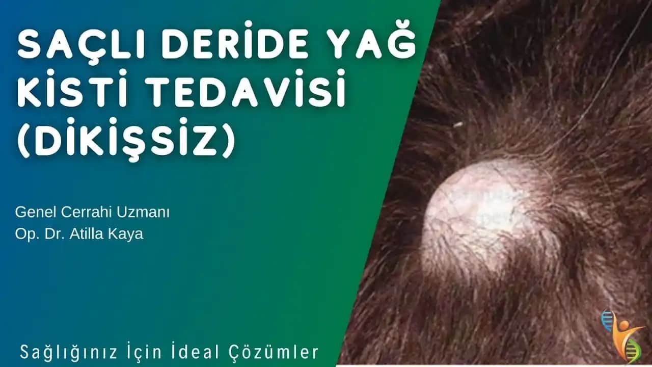 Saç Derisinde Yağ Bezi Oluşumu, Belirtileri ve Tedavi Yöntemleri Hakkında Bilgi