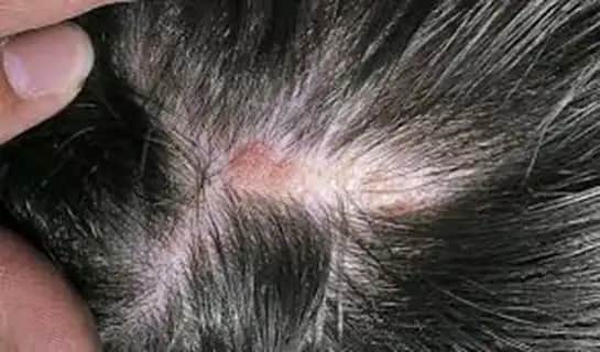 Saç Derisinde Yara Nedenleri ve Sağlıklı Bakım Yöntemleri Rehberi