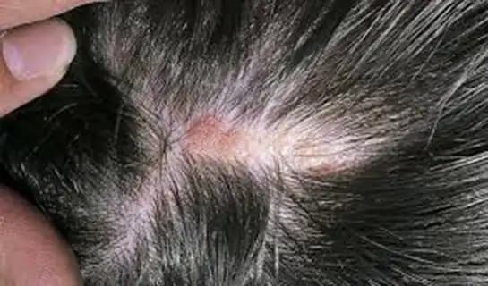 Saç Derisinde Yara Nedenleri ve Sağlıklı Bakım Yöntemleri Rehberi