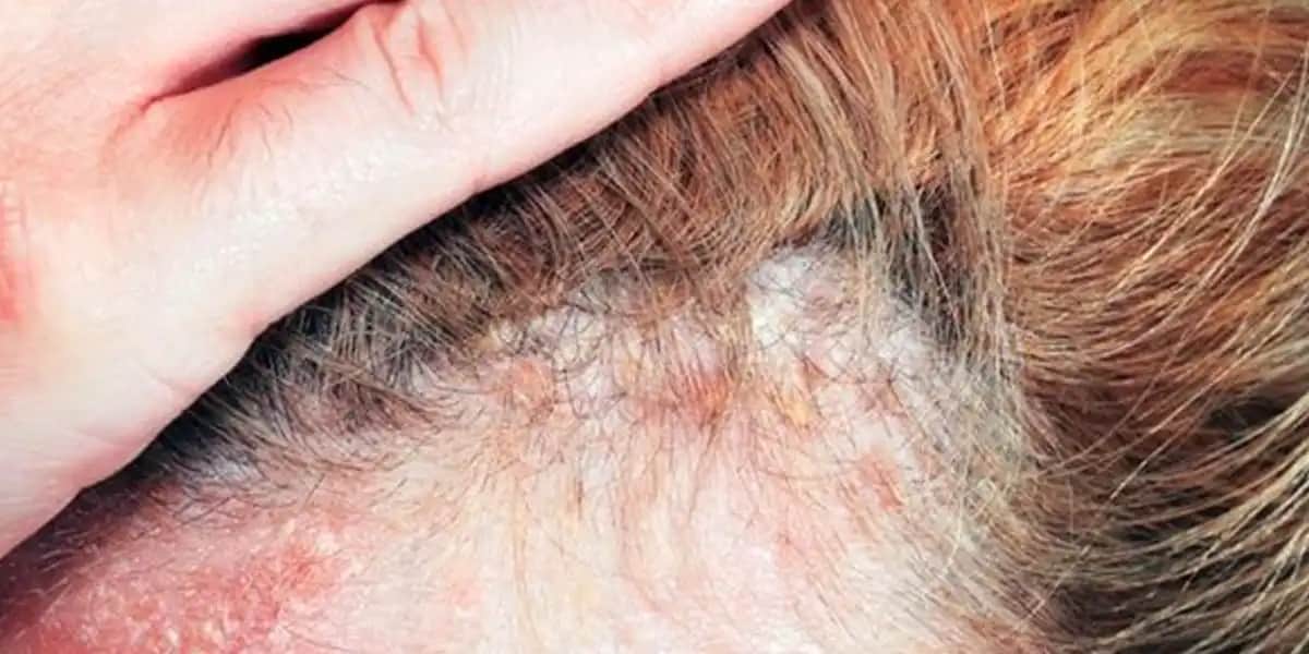 Saç Derisinde Yaralar ve Kabuklanma Nedenleri, Belirtileri ve Etkili Tedavi Yöntemleri