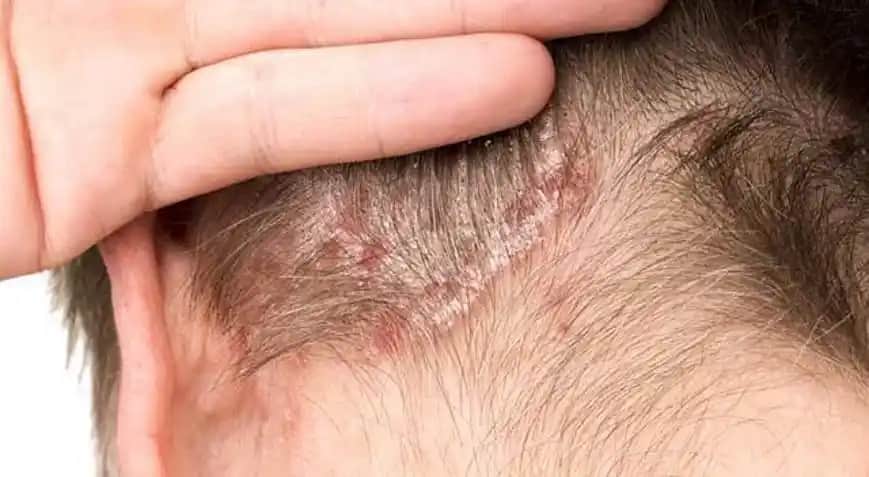 Saç Derisinin Kabuklanması ve Tedavi Yöntemleri: Nedenleri ve Korunma İpuçları