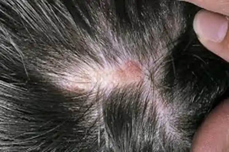 Saç Derisinin Kalkması Nedenleri, Belirtileri ve Korunma Yöntemleri