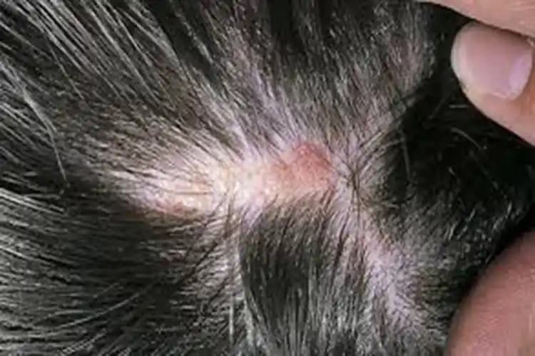 Saç Derisinin Kalkması Nedenleri, Belirtileri ve Korunma Yöntemleri