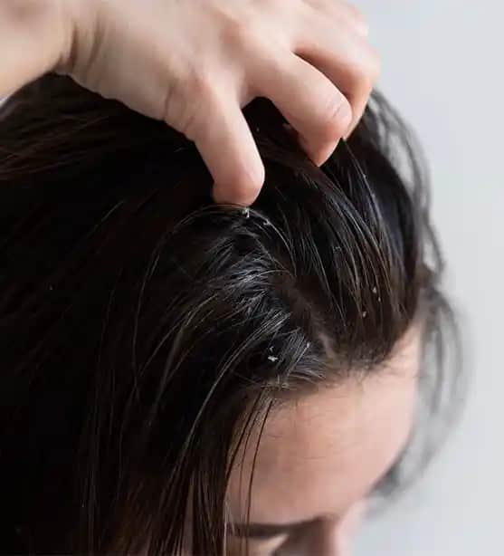 Saç Derisinin Soyulmasının Nedenleri ve Etkili Tedavi Yöntemleri