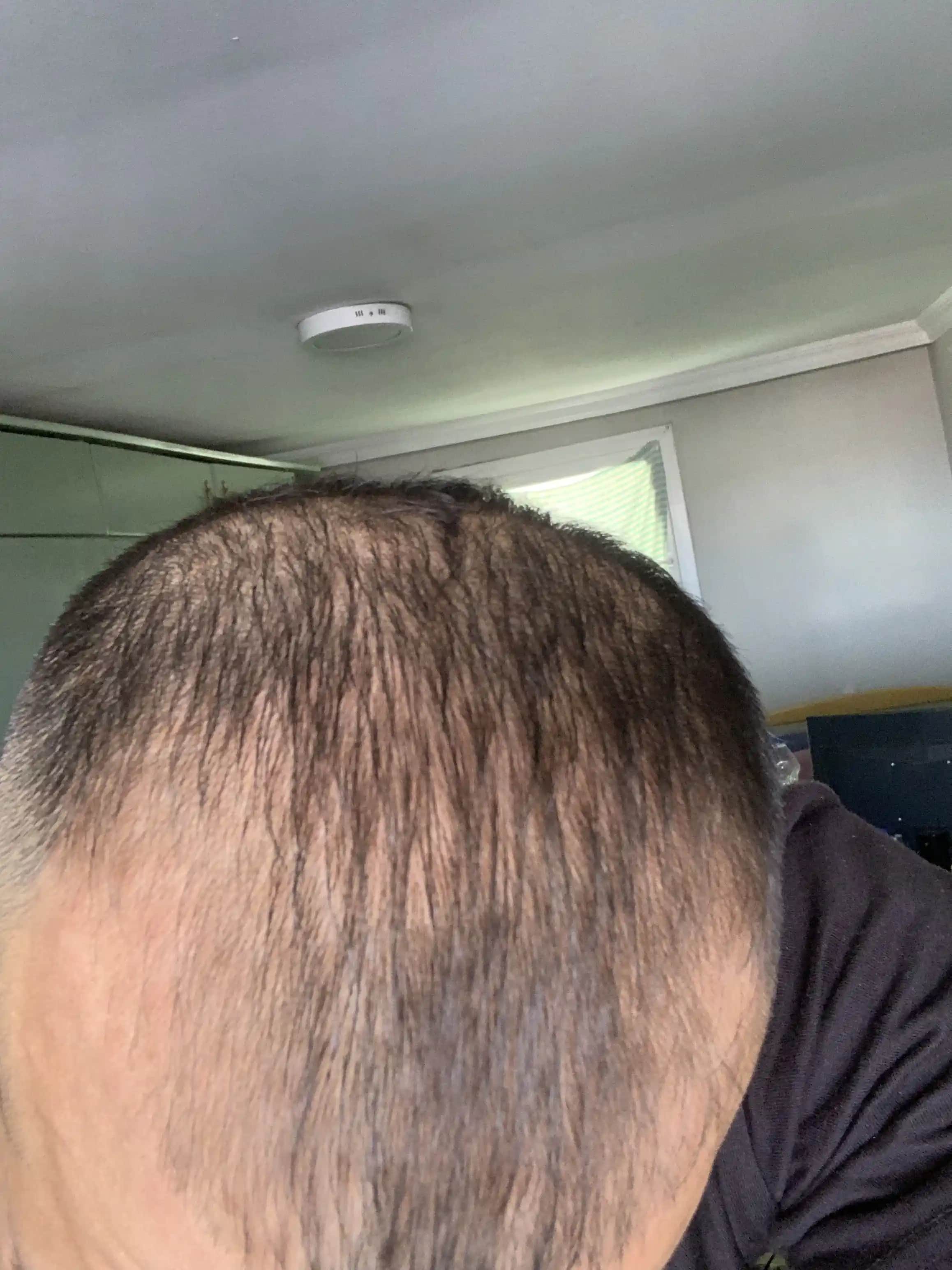 Saç Derisinin Soyulmasının Nedenleri ve Sağlıklı Bir Saç Derisi İçin Öneriler