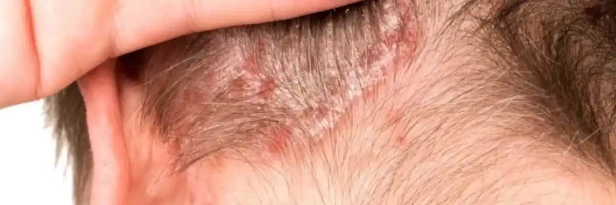 Saç Dibi Egzaması Nedenleri Belirtileri ve Etkili Tedavi Yöntemleri