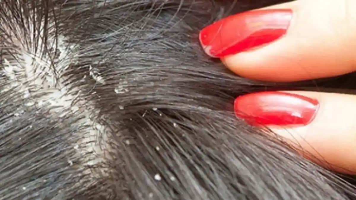 Saç Dibi Egzaması Nedir, Belirtileri, Nedenleri ve Etkili Tedavi Yöntemleri