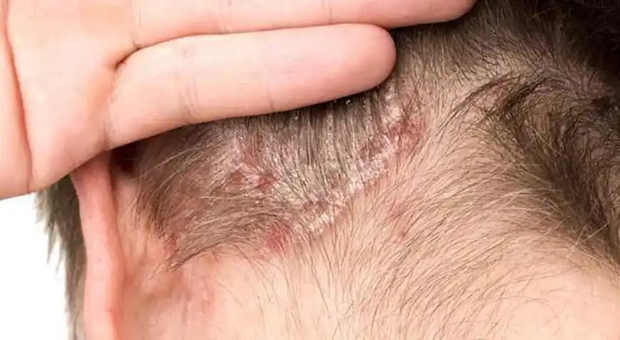 Saç Dibi Kabuklanması ve Saç Sağlığını Koruma Yöntemleri