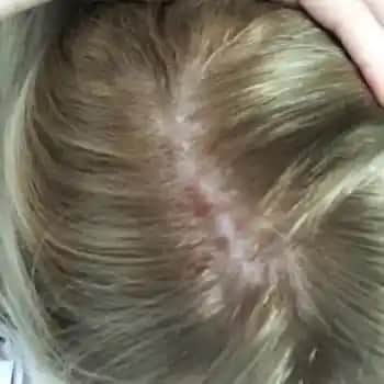 Saç Dibi Yarası Nedenleri Belirtileri ve Etkili Tedavi Yöntemleri Hakkında Bilgi