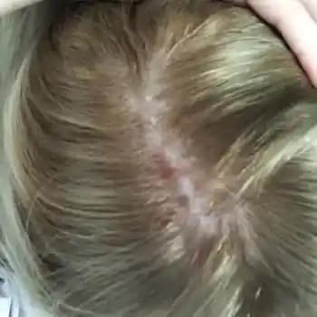 Saç Dibi Yarası Nedenleri Belirtileri ve Etkili Tedavi Yöntemleri Hakkında Bilgi