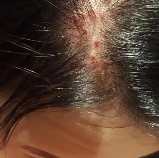 Saç Dibi Yarası ve Kozmetik Yaklaşımlarla Etkili Çözüm Yolları