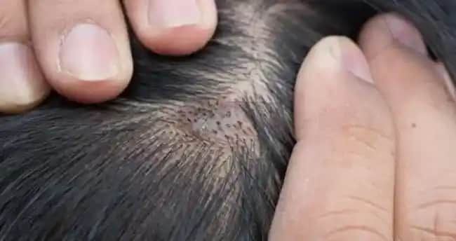 Saç Dipleri Kaşıntısının Nedenleri, Belirtileri ve Etkili Çözüm Yolları