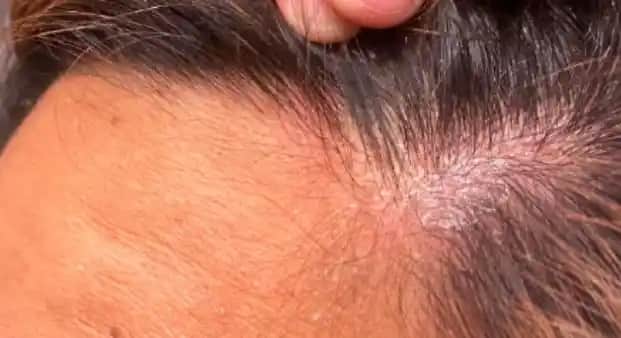 Saç Diplerinde Sarı Kabuklanma Nedenleri Belirtileri ve Çözüm Yolları