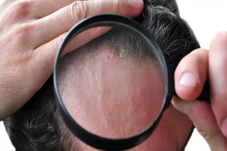 Saç Diplerindeki Sivilcelerin Nedenleri ve Etkili Bakım Yöntemleri