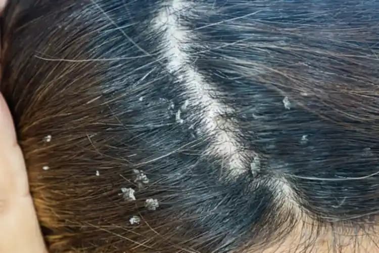 Saç Egzaması Belirtileri, Nedenleri ve Etkili Tedavi Yöntemleri Hakkında Bilgiler