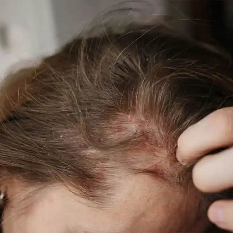 Saç Egzaması Belirtileri, Nedenleri ve Etkili Tedavi Yöntemleri Rehberi