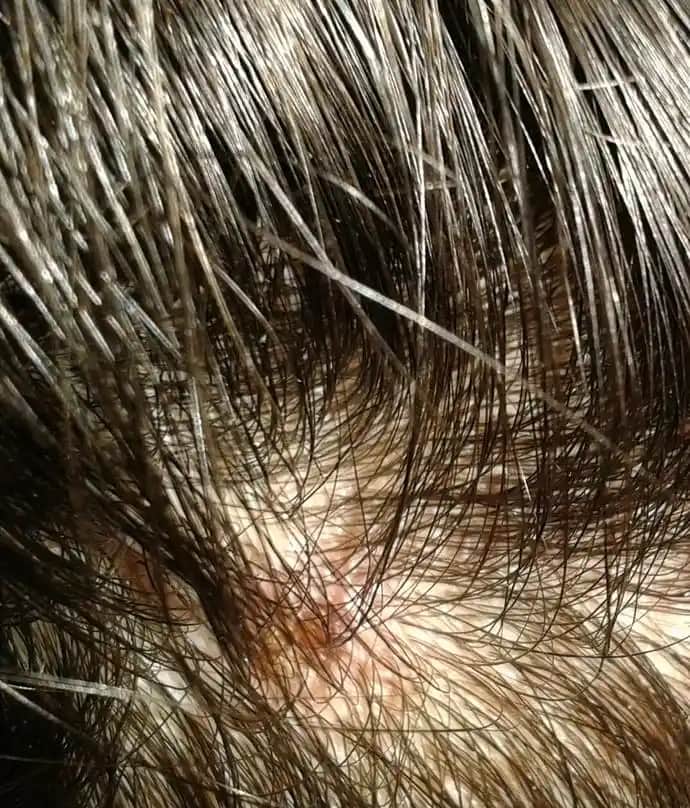 Saç İçinde Çıkan Yaraların Nedenleri, Belirtileri ve Etkili Tedavi Yöntemleri