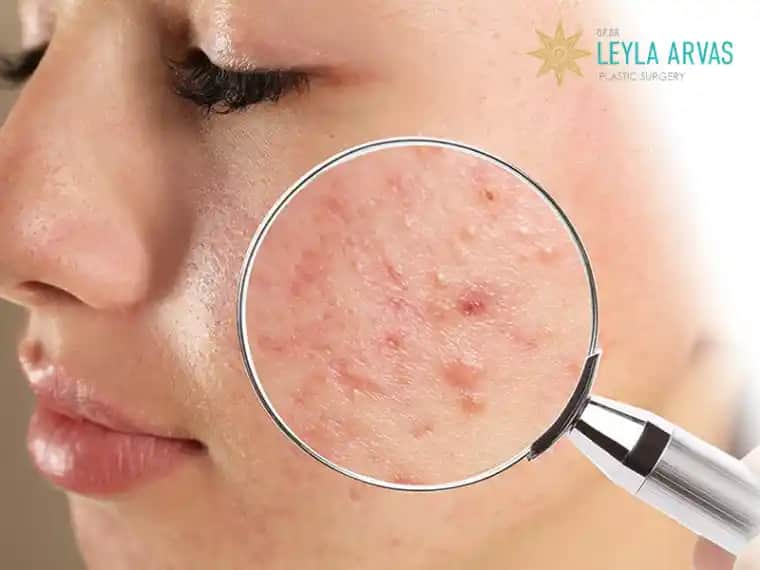 Saç İçinde Sivilce Nedenleri ve Etkili Çözüm Yöntemleri