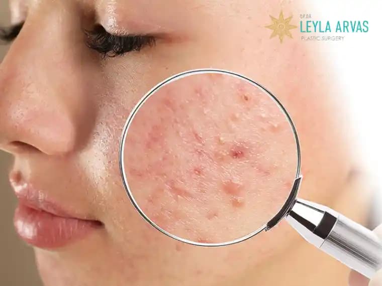 Saç İçinde Sivilce Nedenleri ve Etkili Çözüm Yöntemleri