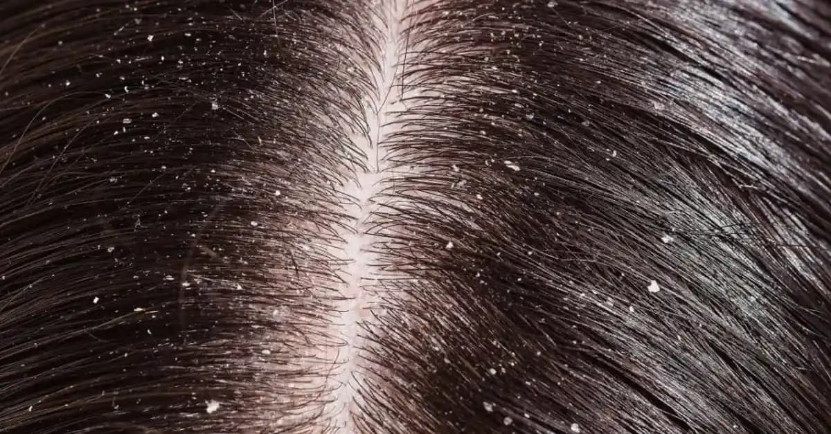 Saç Kepeği Nedenleri ve Etkili Tedavi Yöntemleri Hakkında Detaylı Bilgi