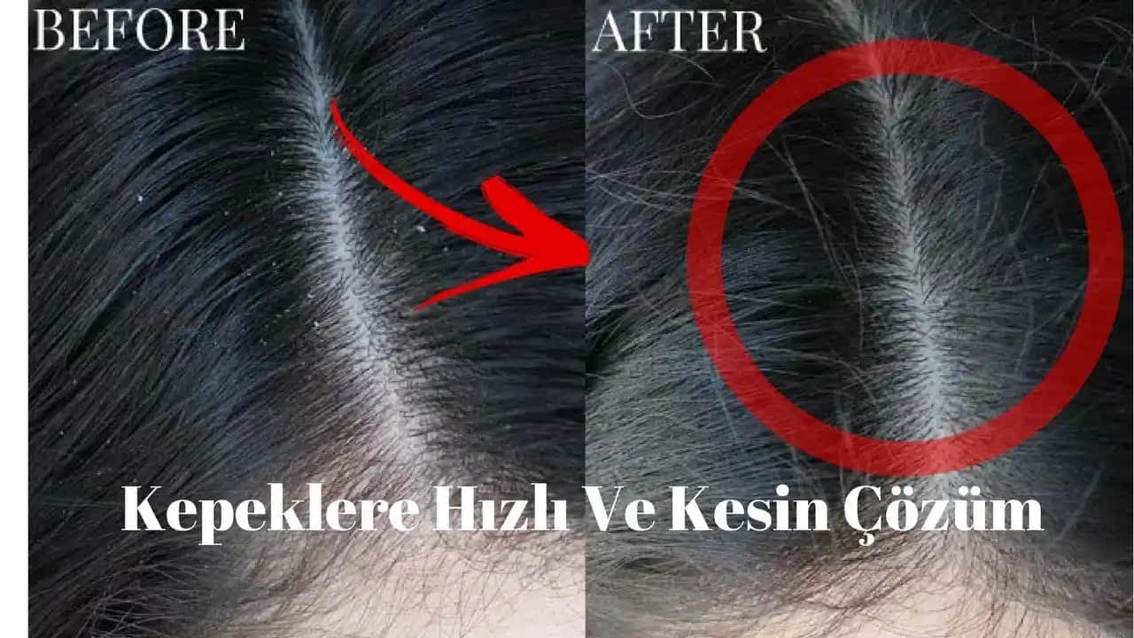 Saç Kepeğinden Kurtulmanın Doğal ve Medikal Yöntemleri Hakkında Kapsamlı Rehber