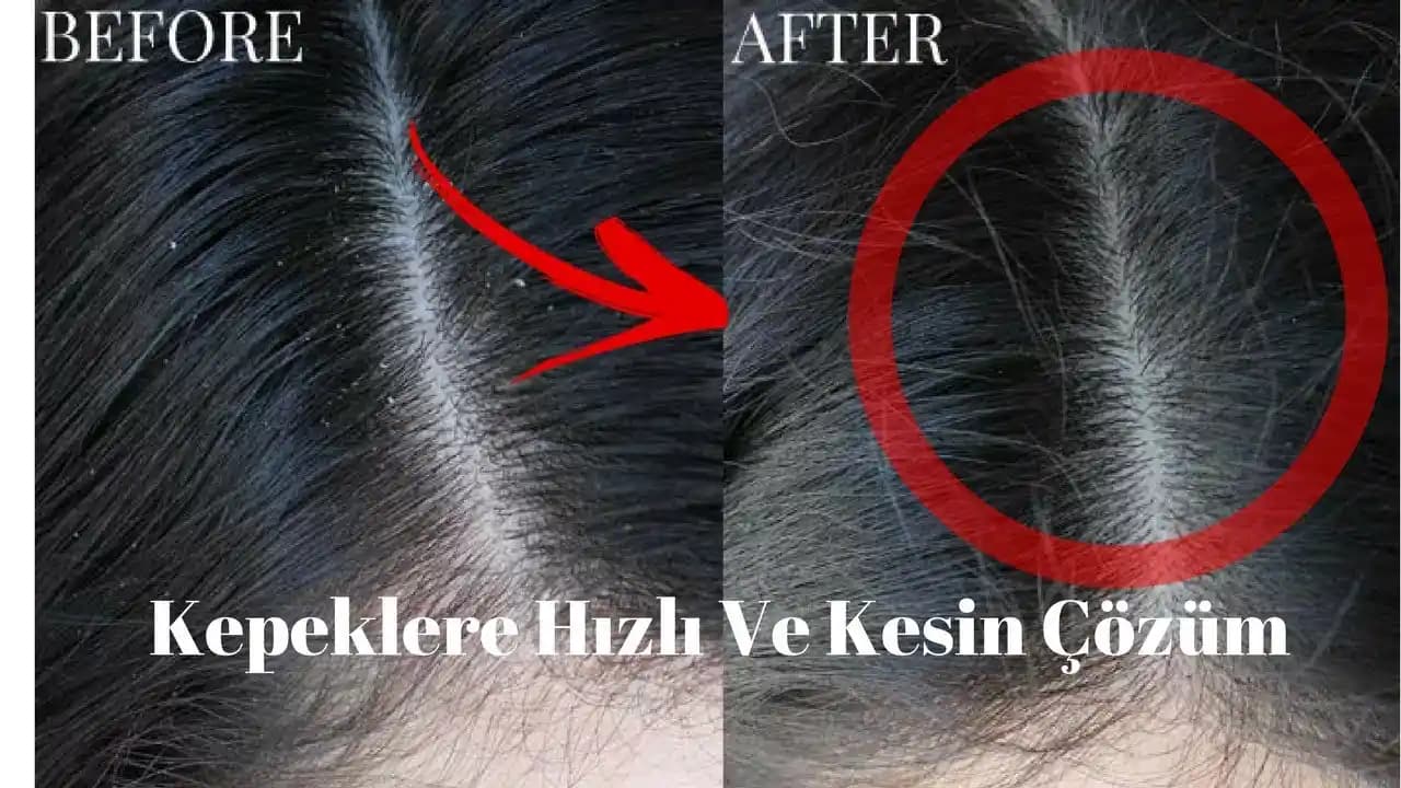 Saç Kepeğinden Kurtulmanın Doğal ve Medikal Yöntemleri Hakkında Kapsamlı Rehber