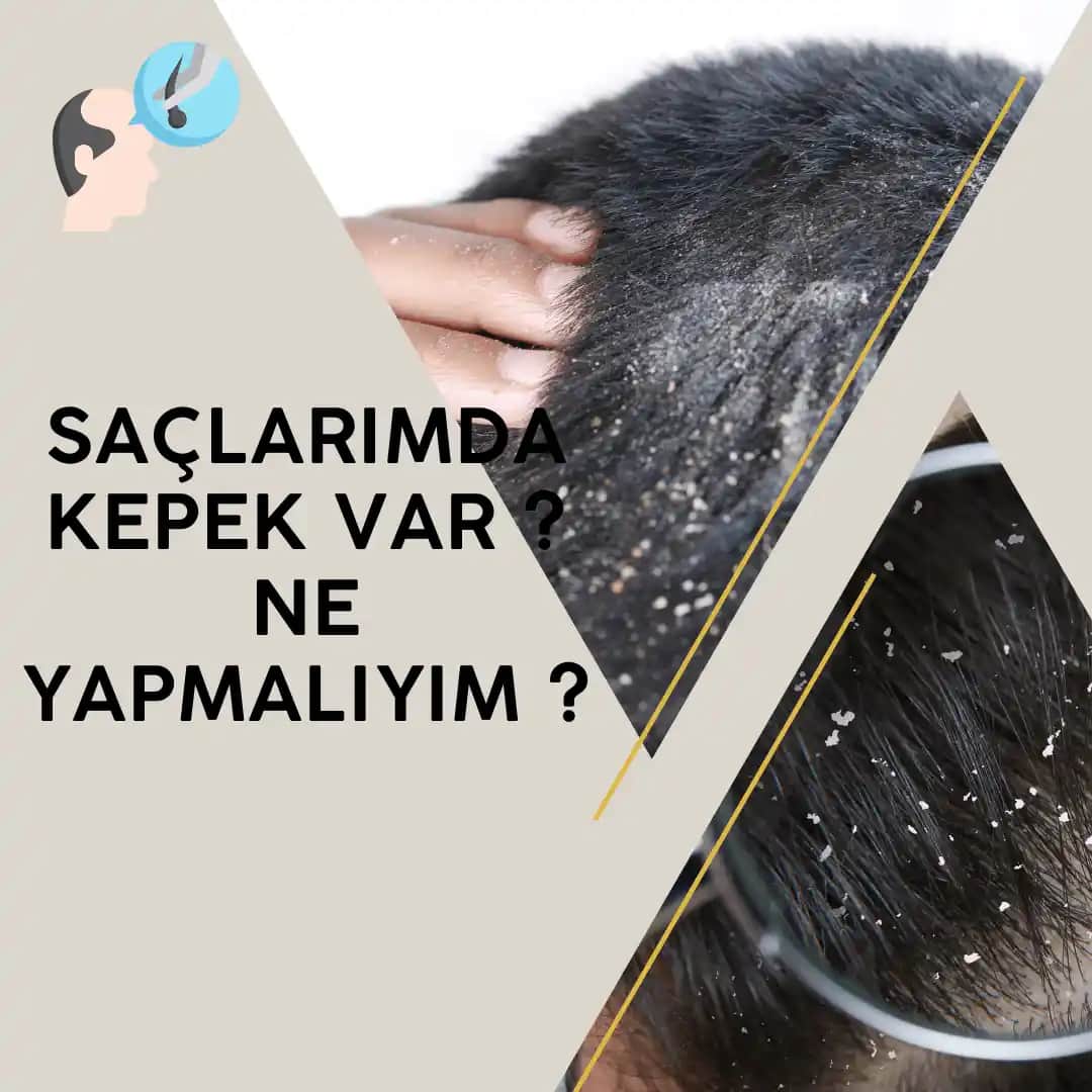 Saç Kepeğiyle Mücadele Yöntemleri ve Doğru Bakım İpuçları