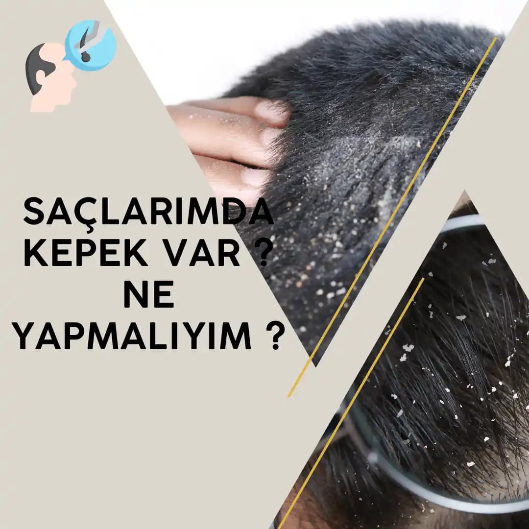 Saç Kepeğiyle Mücadele Yöntemleri ve Doğru Bakım İpuçları