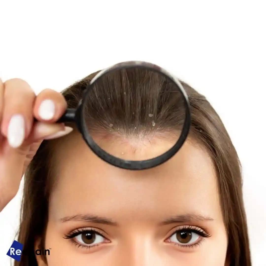 Saç Kepek Sorunu ve Etkili Çözüm Yolları Hakkında Kapsamlı Bilgi