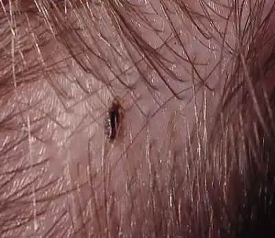 Saç Neden Bitlenir ve Bitlenmeyle Mücadele Yöntemleri Hakkında Kapsamlı Bilgi